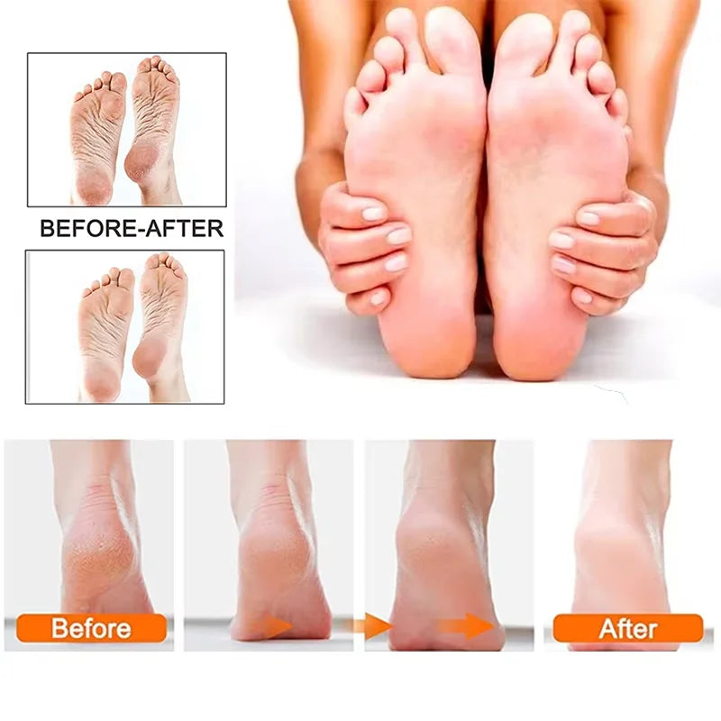  Electric Foot Callus Remover 