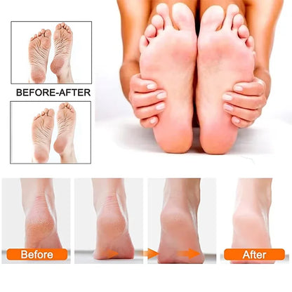  Electric Foot Callus Remover 